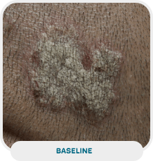 Patient with scalp psoriasis baseline
