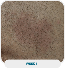 Patient with scalp psoriasis after 1 week of Wynzora treatment