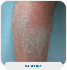 Patient with lower leg psoriasis baseline