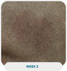 Patient with scalp psoriasis after 2 weeks of Wynzora treatment