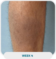 Patient with lower leg psoriasis after 4 weeks of Wynzora treatment