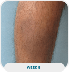 Patient with lower leg psoriasis after 8 weeks of Wynzora treatment