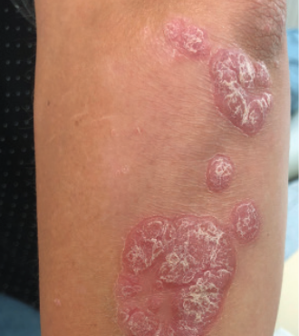 Elbow plaque psoriasis before starting Wynzora treatment