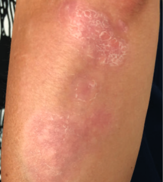 Elbow plaque psoriasis results after 4 weeks of treatment with Wynzora