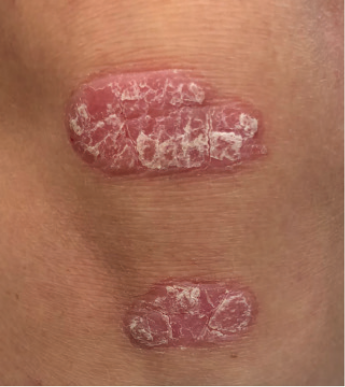 Knee plaque psoriasis before starting Wynzora treatment