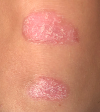 Knee plaque psoriasis results after 1 week of treatment with Wynzora