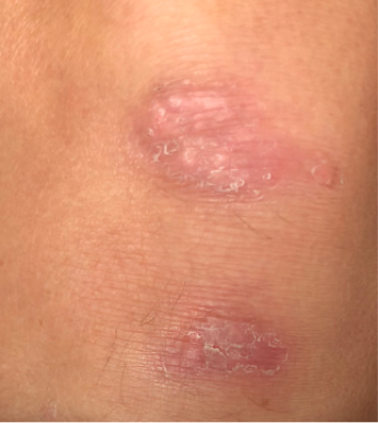 Knee plaque psoriasis results after 4 weeks of treatment with Wynzora