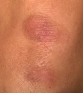 Knee image showing week 8.