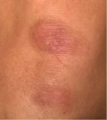 Knee plaque psoriasis results after 8 weeks of treatment with Wynzora