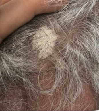 Scalp plaque psoriasis before starting Wynzora treatment