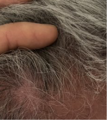 Scalp plaque psoriasis results after 1 week of treatment with Wynzora