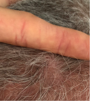 Scalp plaque psoriasis results after 4 weeks of treatment with Wynzora