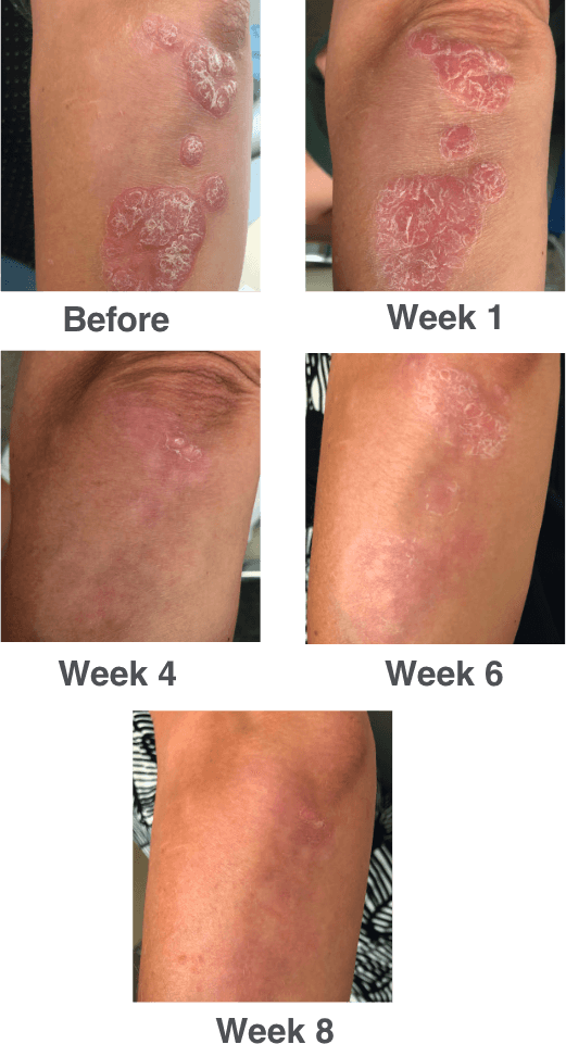 weekly progressions of knees using Wynzora